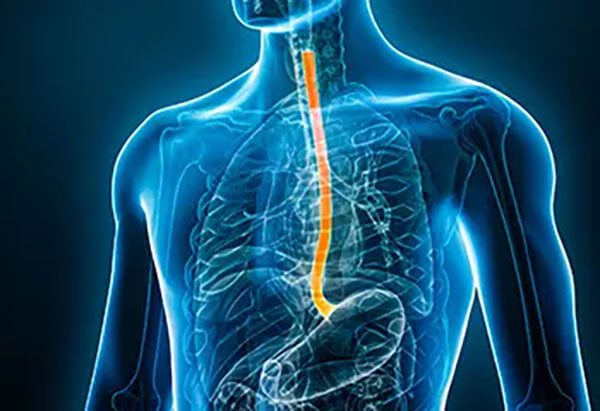 Esophageal Health and Reflux