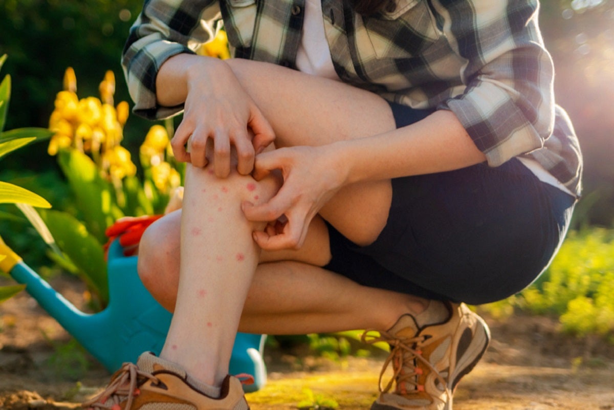 types of bug bites, bug bite treatment, bug bites