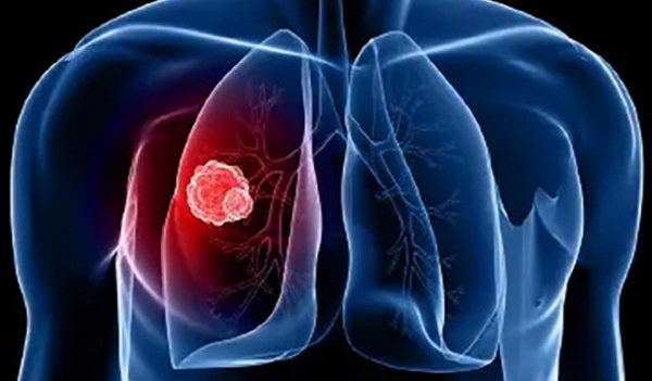 Cancer Types & Prevention