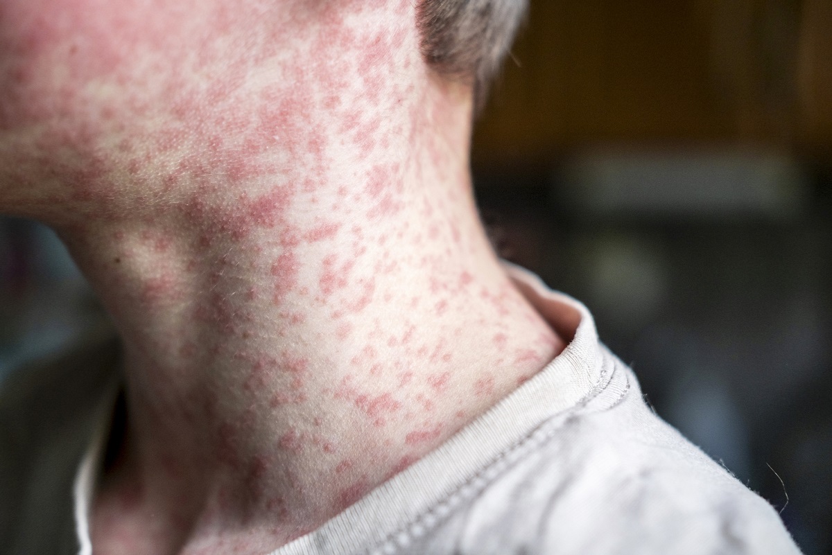 measles, measles outbreak, measles vaccine, mmr vaccine