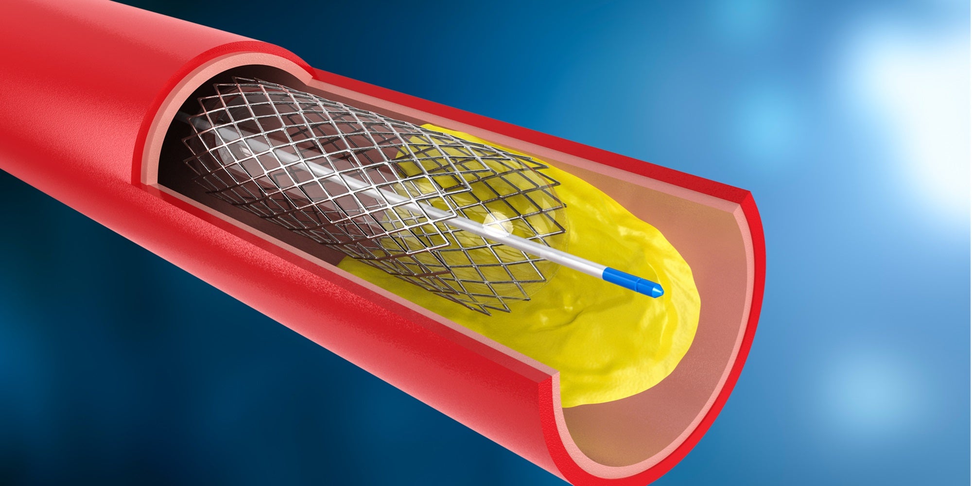 stenting, angioplasty