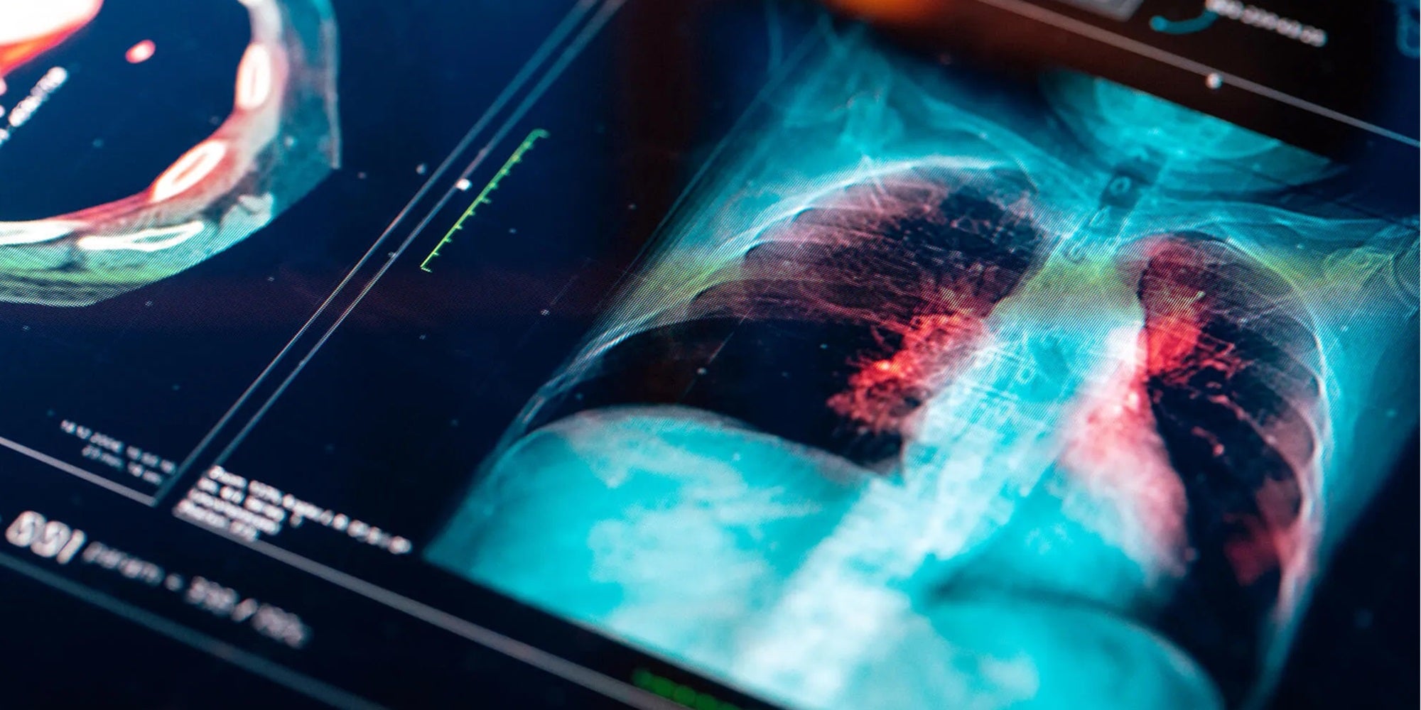 lung cancer screening, lung cancer treatment