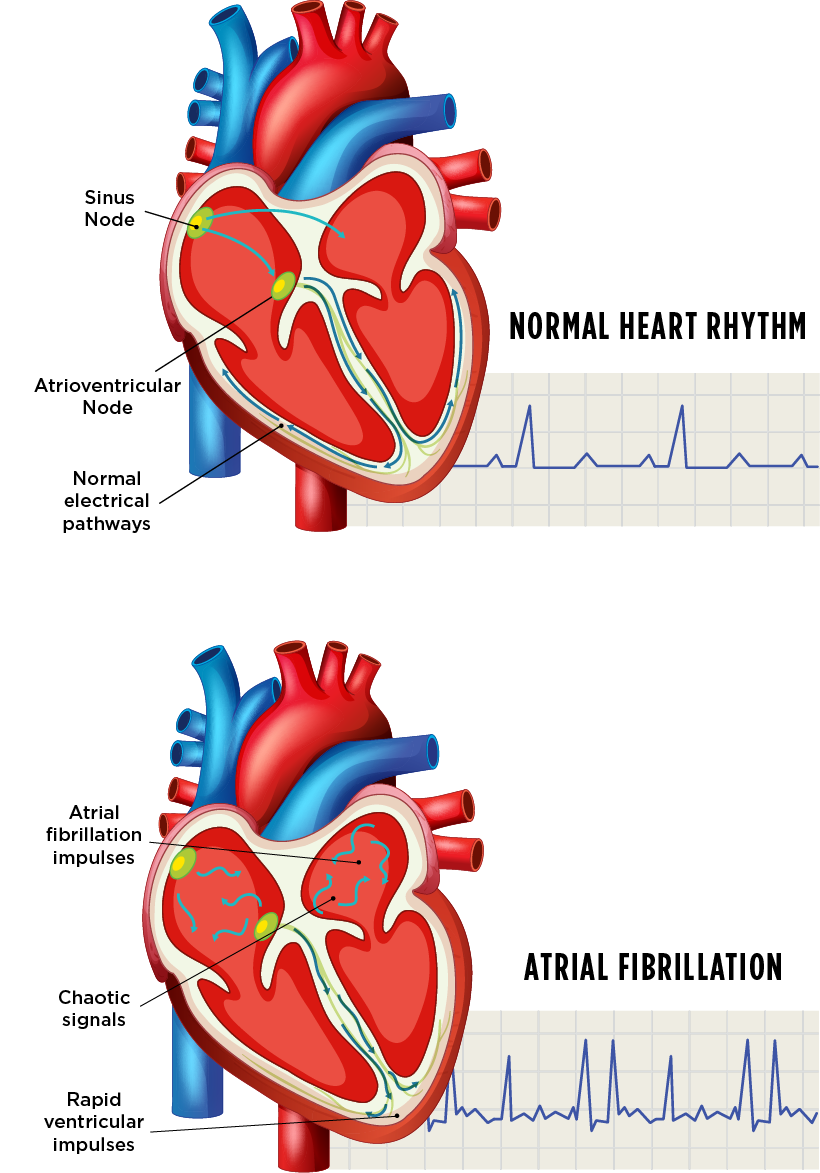 Discover What Causes AFib: A Detailed Guide