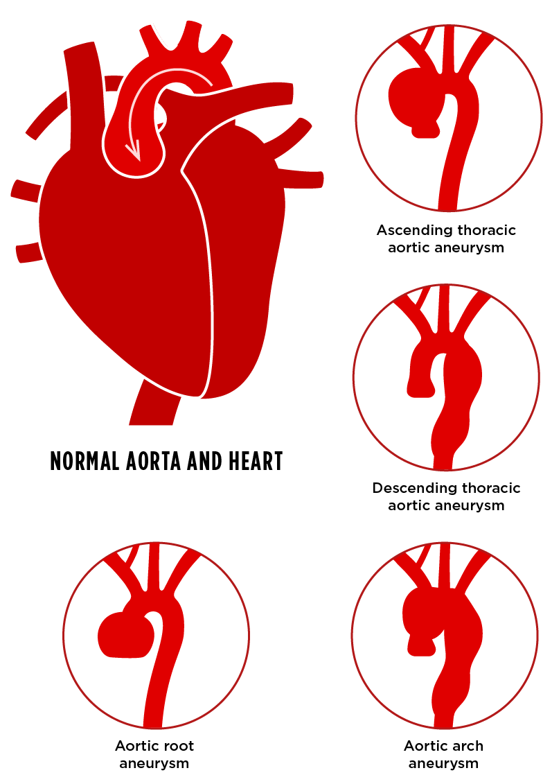 integrated aortic program