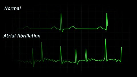 CardiaMend: New Patch to Stop Post-Operative Atrial Fibrillation?