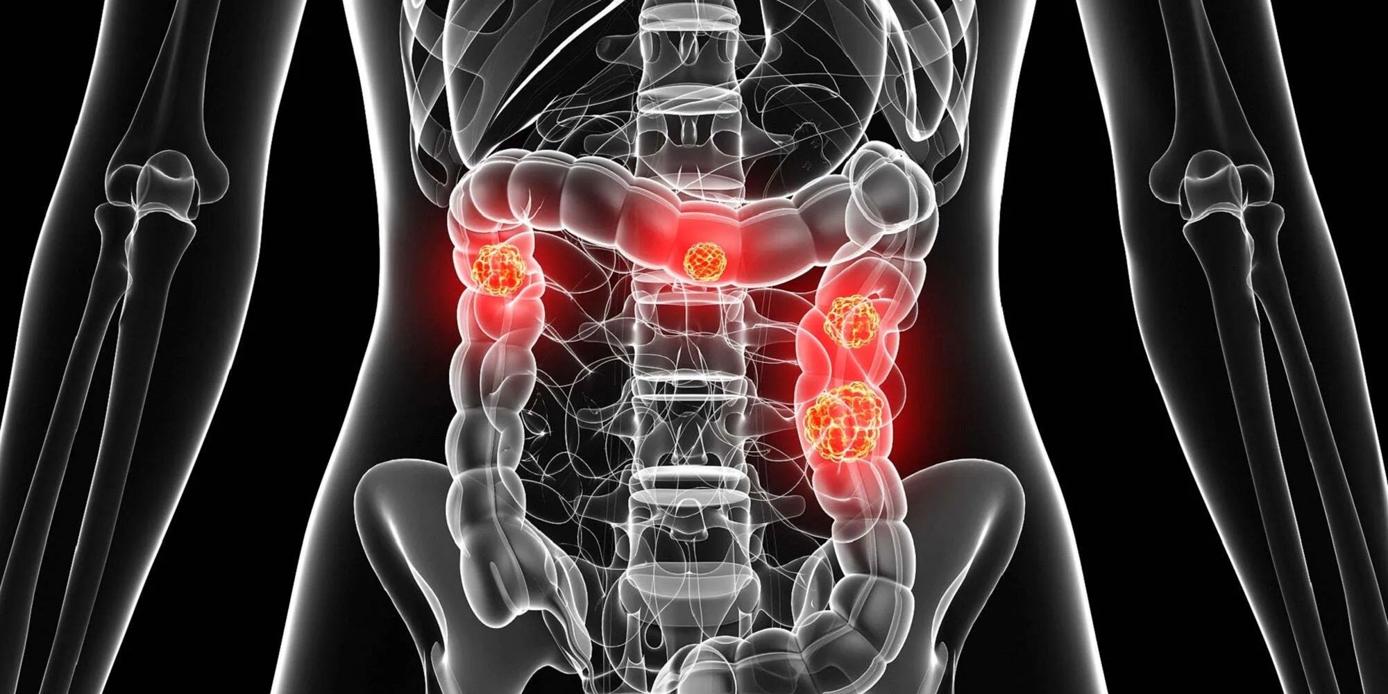 symptoms of colon cancer, colon cancer, colon cancer symptoms