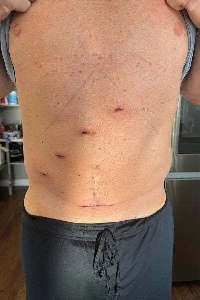 Taylor's incisions