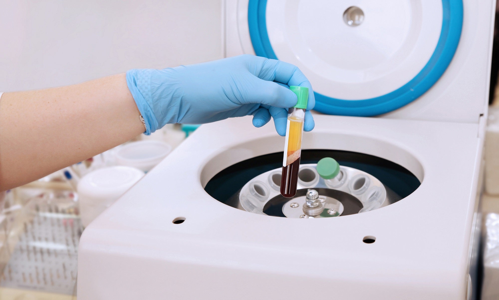 prp injections, prp, prp treatment