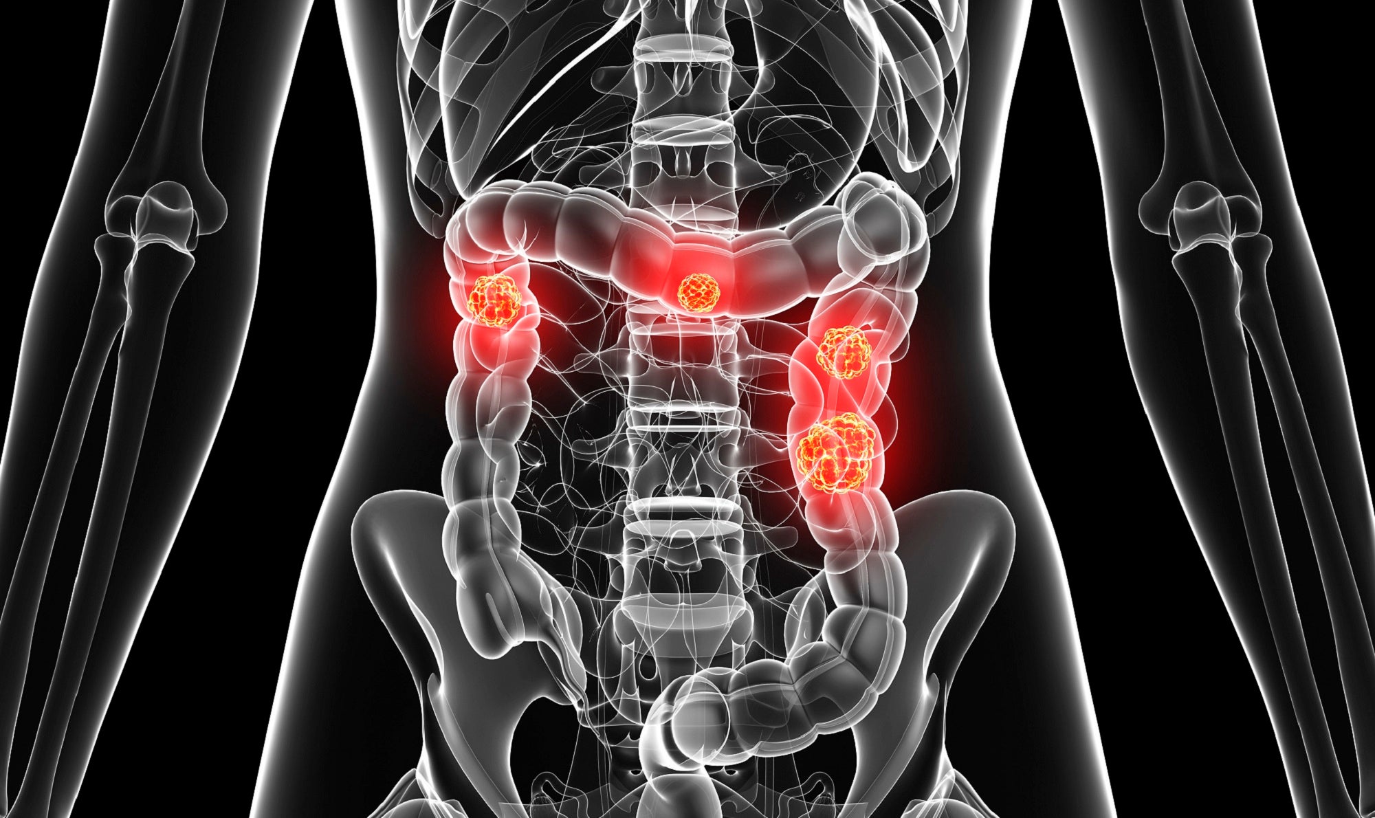 symptoms of colon cancer, colon cancer, colon cancer symptoms