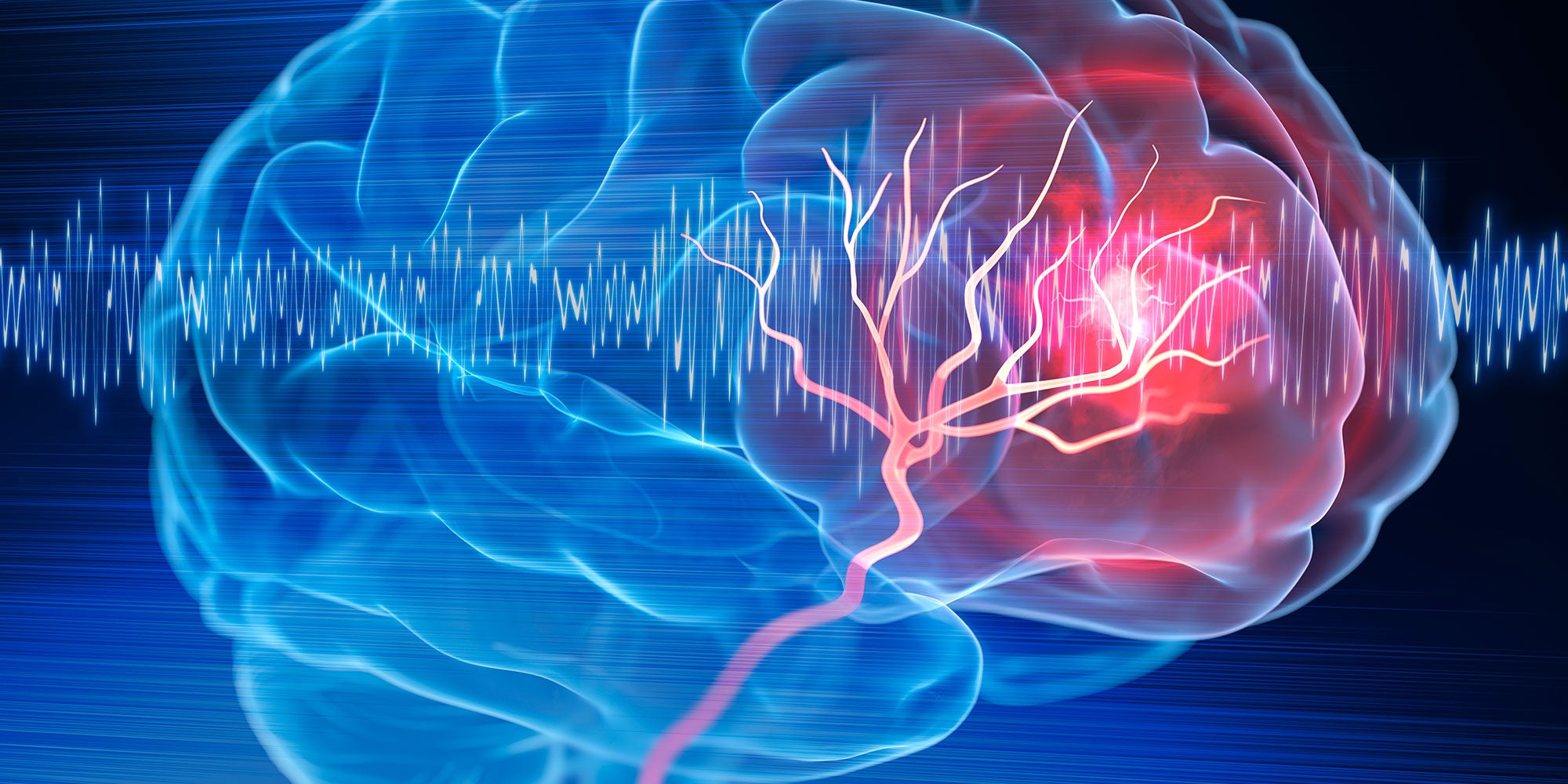 stroke prevention, stroke risk factors