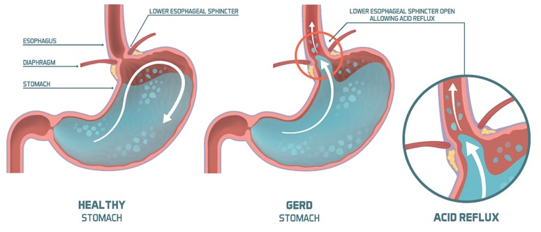 Normal stomach vs. GERD stomach