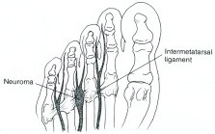 interdigital neuroma, mortons neuroma