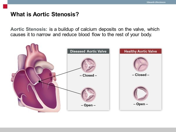 atrial septal defects, structural heart, atrial septal defects, aortic stenosis, structural heart program